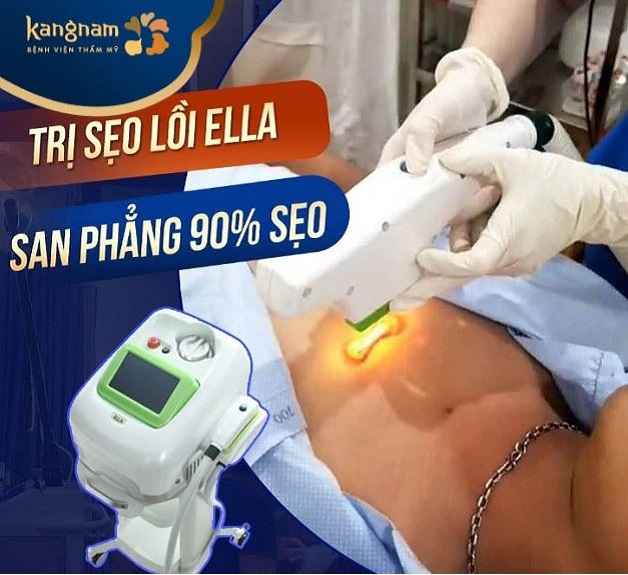 Trị sẹo lồi công nghệ ELLA