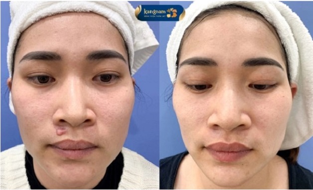 Chị Nguyễn Phượng điều trị sẹo lồi tại Kangnam Cần Thơ