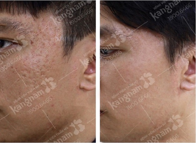 Bạn Quang Huy trước và sau điều trị sẹo rỗ tại Kangnam Cần Thơ