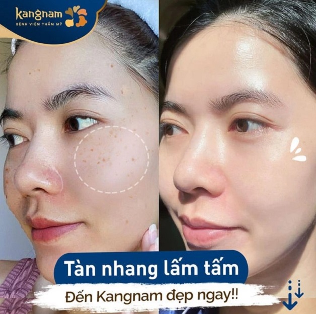 Trị tàn nhang bằng công nghệ Picosure