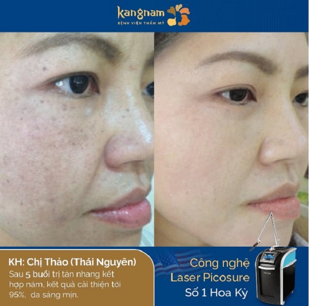 Chị Thảo sau 5 buổi trị tàn nhang kết hợp trị nám