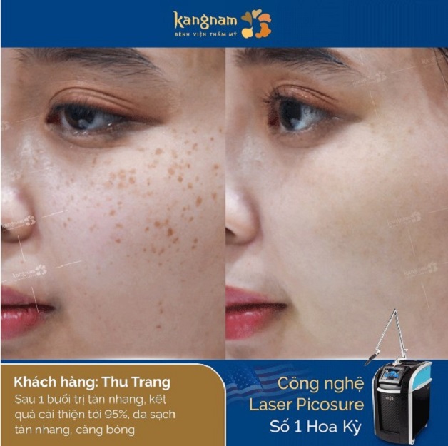 Chị Thu Trang sau 1 buổi trị tàn nhang 