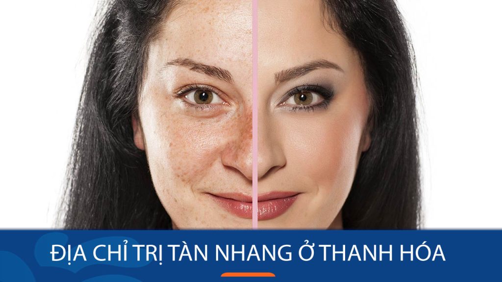 Địa chỉ trị tàn nhang ở Thanh Hóa Tận gốc – Không tái phát