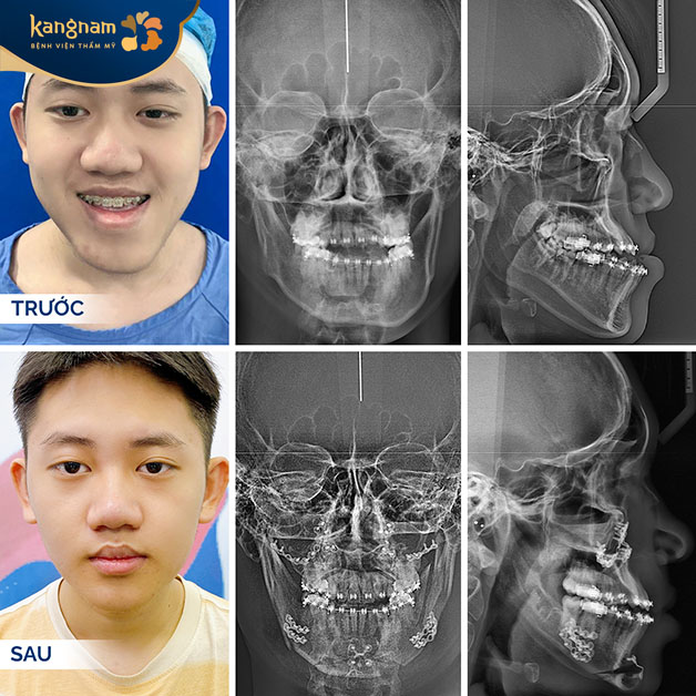 Cằm chẻ là một nét đẹp không chỉ phái đẹp mà cả cánh mày râu cũng khao khát sở hữu