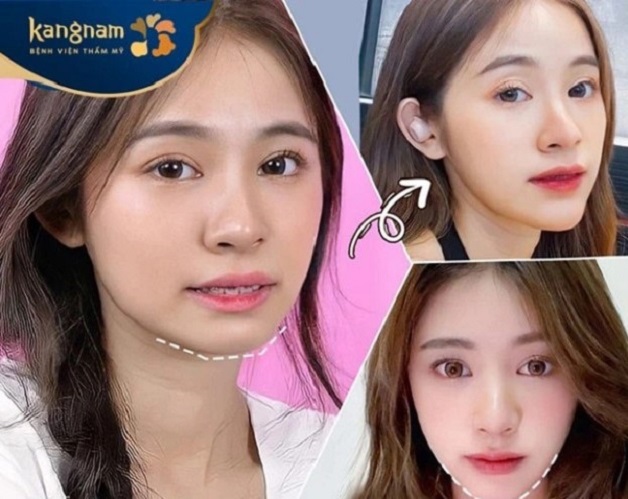 Bạn Thúy Hiền tự tin với chiếc cằm mới sau phẫu thuật