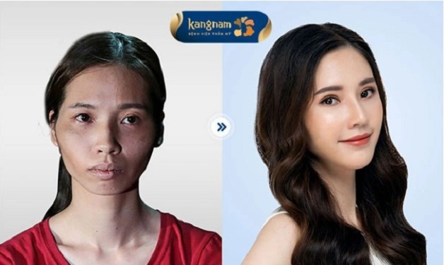 Chị Quỳnh Anh có màn “lột xác” ngoạn mục sau trượt cằm kết hợp làm các dịch vụ thẩm mỹ khác tại Kangnam