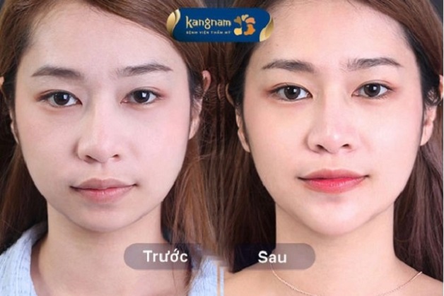 Bạn Trúc Linh sau 4 tháng trượt cằm tại Kangnam Đà Nẵng
