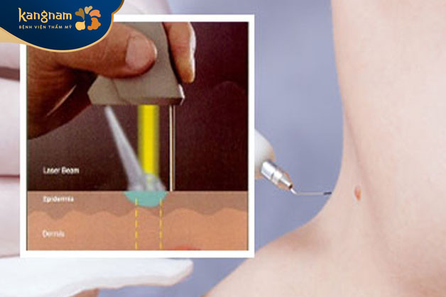 công nghệ hiện đại Laser CO2 siêu xung điều trị mụn cóc