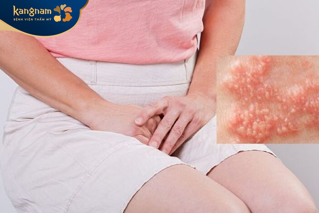 Điều trị sùi mào gà