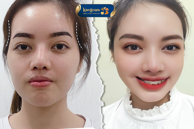 Độn thái dương tại Kangnam là quy trình an toàn