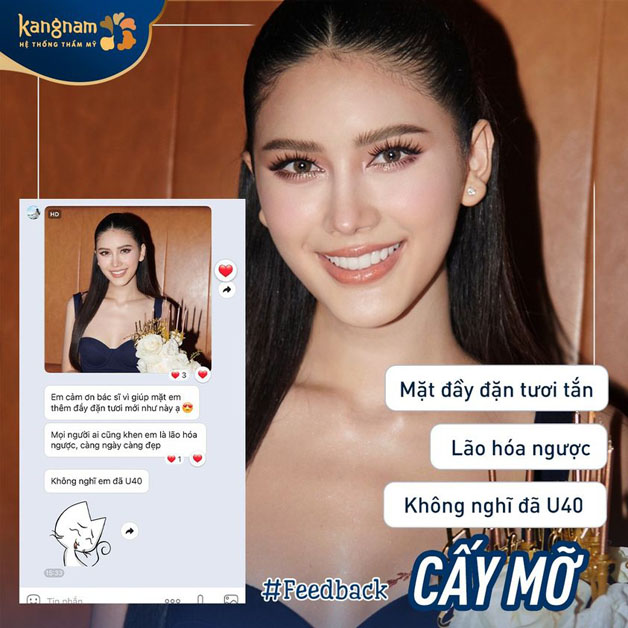 Feedback của khách hàng cấy mỡ mặt tại Kangnam