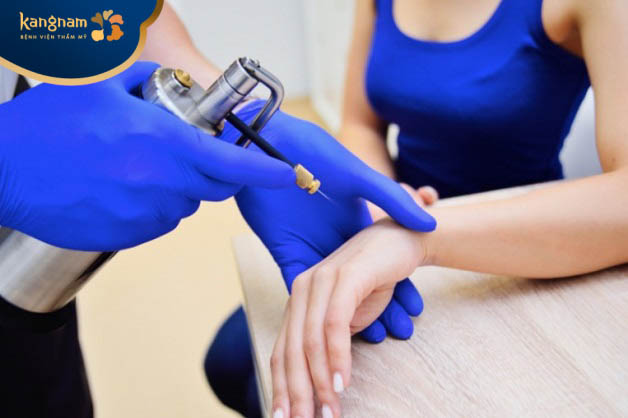 Phương pháp áp lạnh điều trị mụn cóc