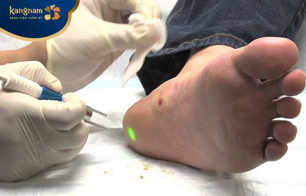 Phương pháp laser trị mụn cóc