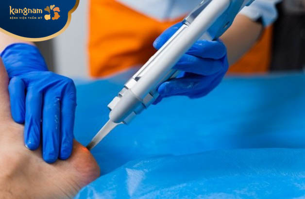 Lựa chọn phương pháp điều trị mụn cóc phù hợp