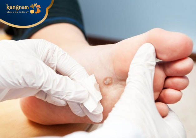 Phương pháp ảnh hưởng đến giá của một liệu trình trị mụn cóc