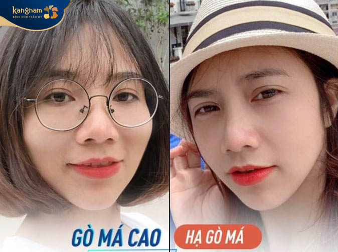 Khách hàng Lan Hương thay đổi ngoạn mục sau khi hạ gò má