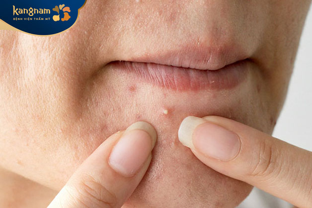 Mụn ẩn khi đã chín nếu không được nặn, nốt nhân mụn sẽ khô dần và tự rụng