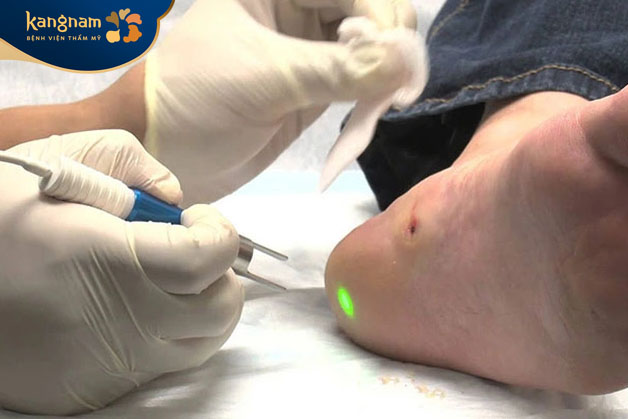 Phương pháp điều trị bằng laser CO2 siêu xung ít gây đau đớn