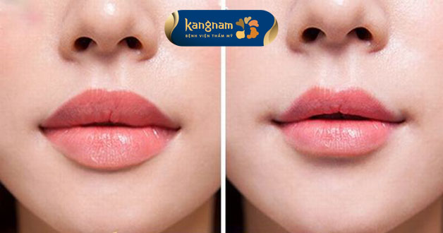 Có thể lựa chọn tiêm filler để tạo môi tim hoặc khóe môi cười