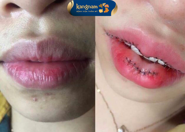 Thủ thuật tiểu phẫu cắt bỏ mô tạo để tạo hình môi là phương pháp cải thiện hợp lý