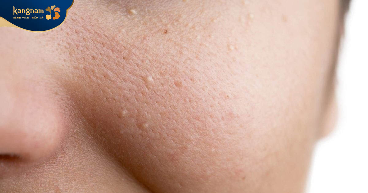 Mụn ẩn có tự hết không - chắc chắn không thể tự hết