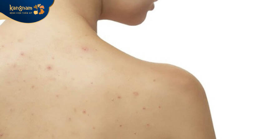 Mụn ẩn mọc ở lưng do bụi bẩn, bã nhờn tích tụ gây tắc lỗ chân lông