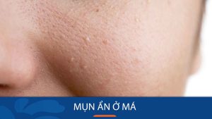 Giải mã bí ẩn mụn ẩn ở má: Từ nguyên nhân, dấu hiệu đến cách điều trị hiệu quả