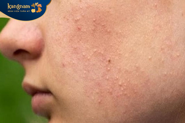 Mụn ẩn ở má