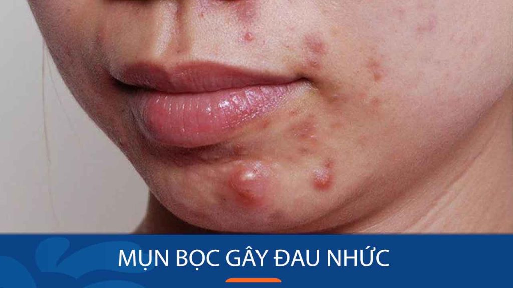 Bí kíp “đánh bay” mụn bọc sưng to, GIẢM ĐAU NHANH CHÓNG chỉ trong 7 ngày