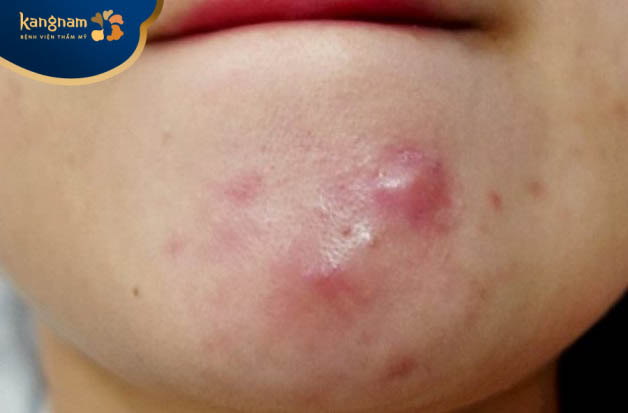 Mụn bọc sưng đỏ gây đau nhức
