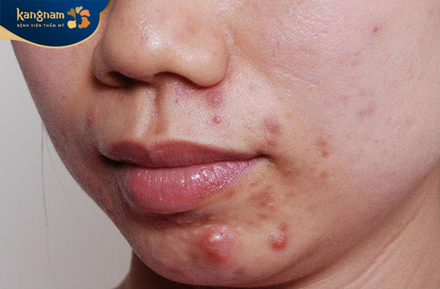 Mụn bọc mãi không xẹp do vi khuẩn hoạt động dưới da không thể thoát ra ngoài