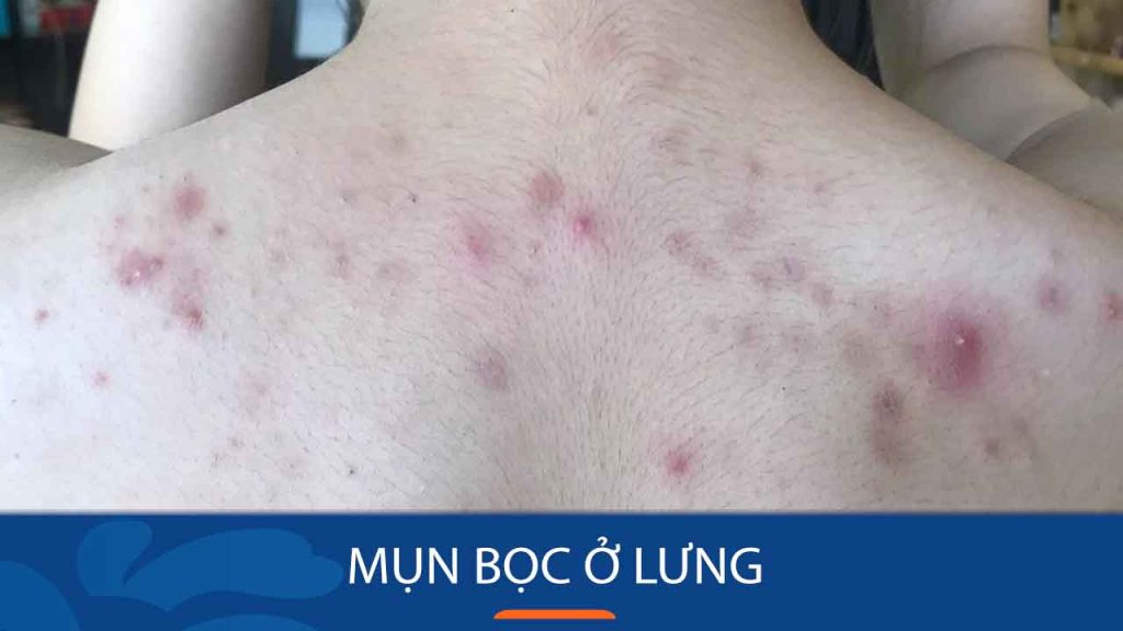 Mụn bọc ở lưng – Nỗi ám ảnh dai dẳng: Nguyên nhân và cách đánh bay hiệu quả