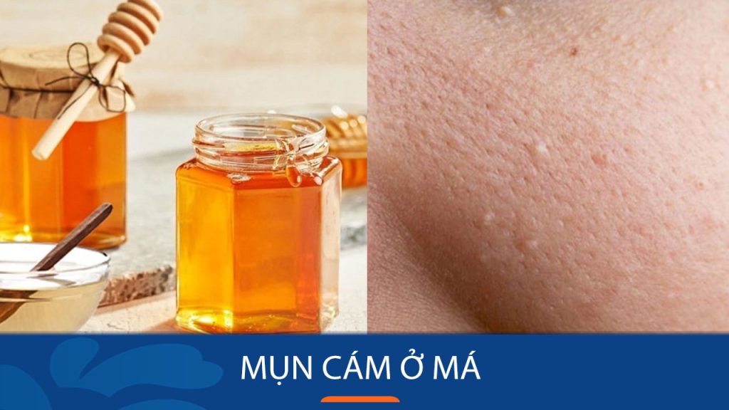 8 Cách Đánh Bay Mụn Cám Má Chỉ Trong 7 Ngày – Nhanh Chóng & Hiệu Quả