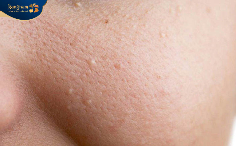 Tác nhân hình thành mụn cám 