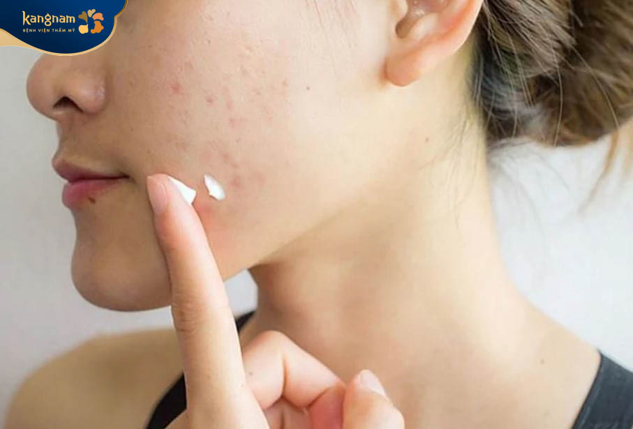Dùng thuốc bôi trị mụn