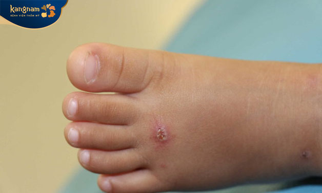 Điều trị không đúng cách sẽ để lại sẹo xấu trên da 