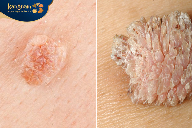 Ảnh mụn cóc sinh dục bên trái, sùi mào gà bên phải