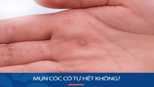 Mụn cóc có tự hết không? Cách điều trị hiệu quả, an toàn tại nhà