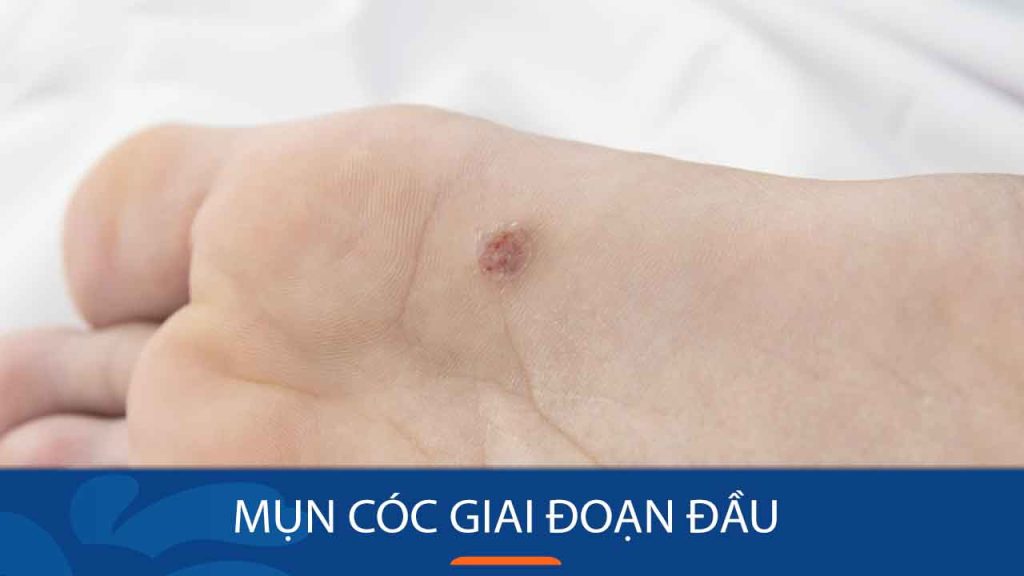 Mụn cóc giai đoạn đầu: 6 Cách khiến mụn cóc tự rụng