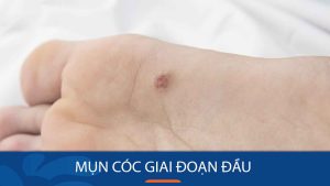 Mụn cóc giai đoạn đầu: 6 Cách khiến mụn cóc tự rụng