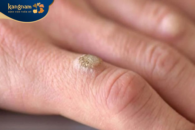 Mụn cóc ở tay không phải là sùi mào gà