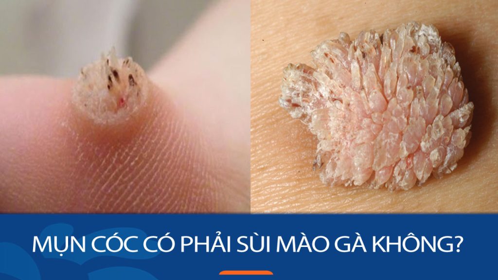 Mụn cóc hay sùi mào gà? Giải đáp thắc mắc và cách phân biệt