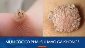Mụn cóc hay sùi mào gà? Giải đáp thắc mắc và cách phân biệt