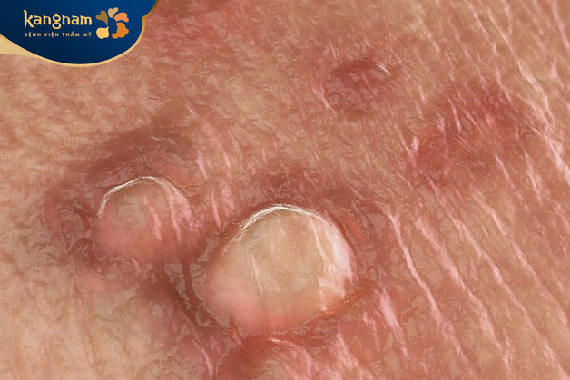 Mụn cóc sinh dục