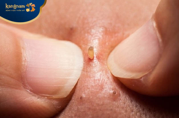 Bị mụn đầu đen có nên nặn không? - Nặn mụn có thể gây kích ứng da