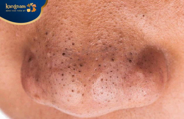 Mụn đầu đen không nặn có sao không?