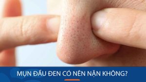 Mụn đầu đen có nên nặn không? Giải đáp từ bác sĩ Kangnam
