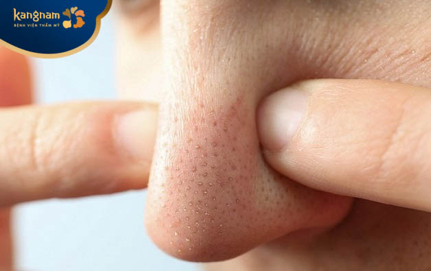 Bị mụn đầu đen có nên nặn không?