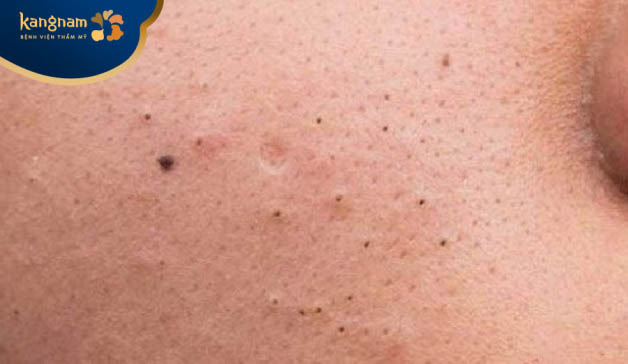 Mụn ở tuổi dậy thì kéo dài từ 2-5 năm