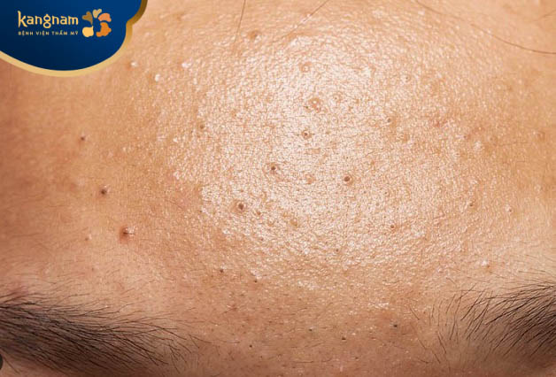 không được tự ý nặn mụn, nhất là khi chưa có kỹ năng, chưa có kiến thức về mụn